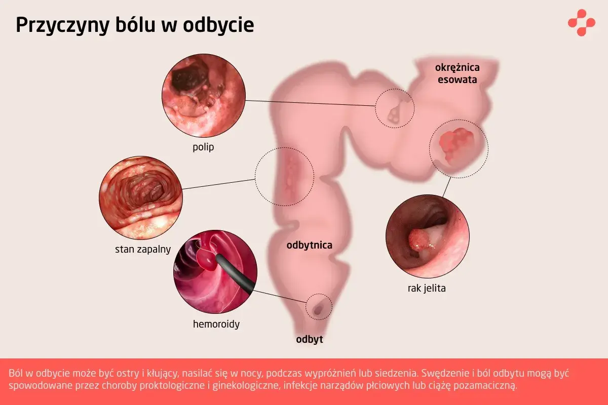 Ilustracja przedstawia schemat jelita grubego z zaznaczonymi zmianami: polip, stan zapalny, hemoroidy, rak jelita.