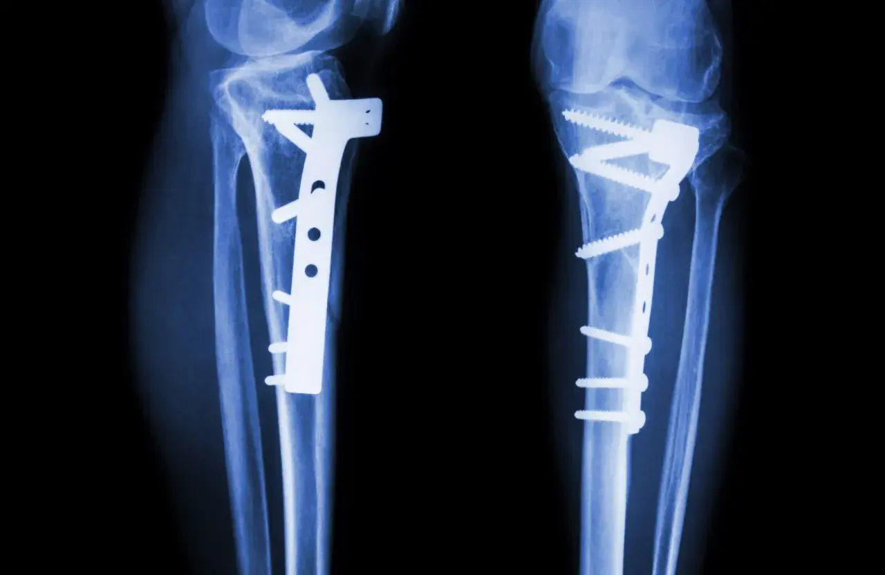 RTG kolan z implantami i śrubami po osteotomii.