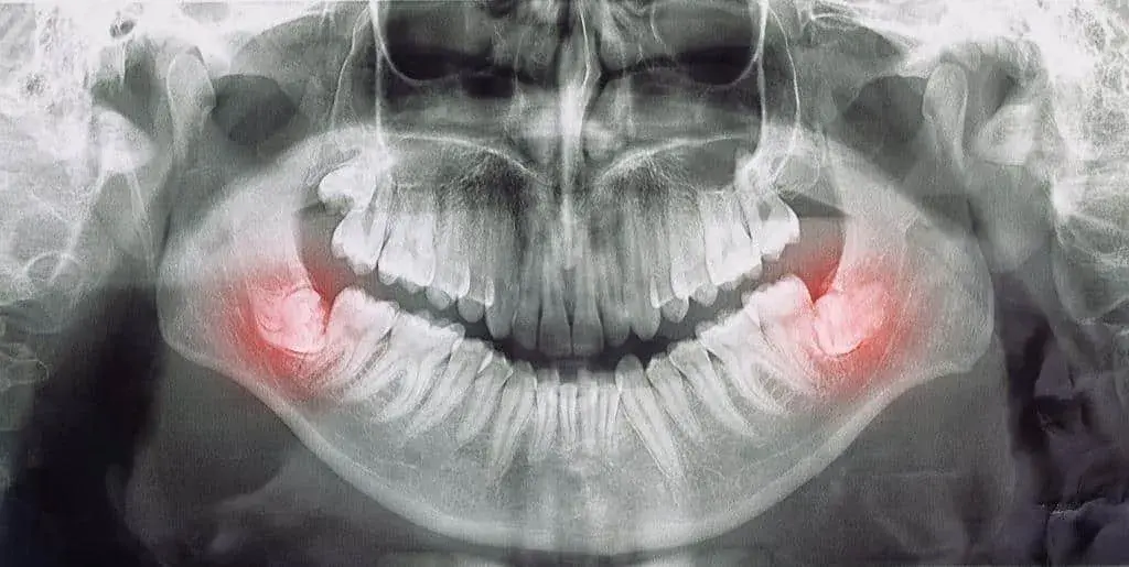 Gdzie z bólem zęba Chełm? Znajdź natychmiastową pomoc dentystyczną