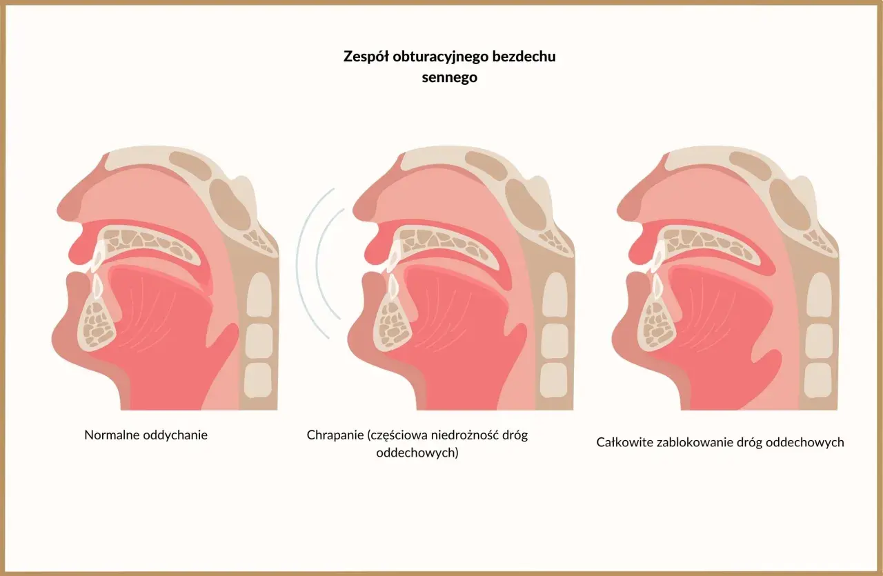 Ilustracja pokazuje przekrój dróg oddechowych. Od normalnego oddychania, przez częściową niedrożność powodującą chrapanie, aż do całkowitego zablokowania, które jest objawem bezdechu sennego.