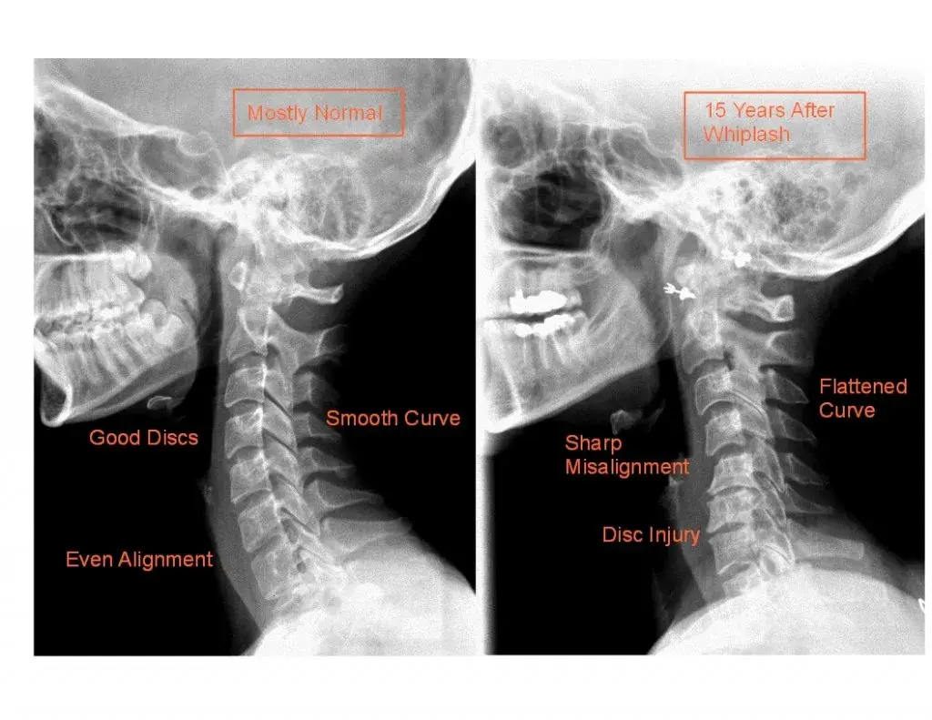 Skręcenie kręgosłupa szyjnego: niebagatelne objawy neurologiczne, które musisz znać