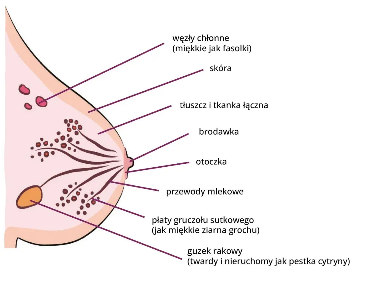 Schemat budowy piersi z zaznaczonymi elementami: skóra, brodawka, przewody mlekowe, płaty gruczołu sutkowego, węzły chłonne i guzek rakowy.