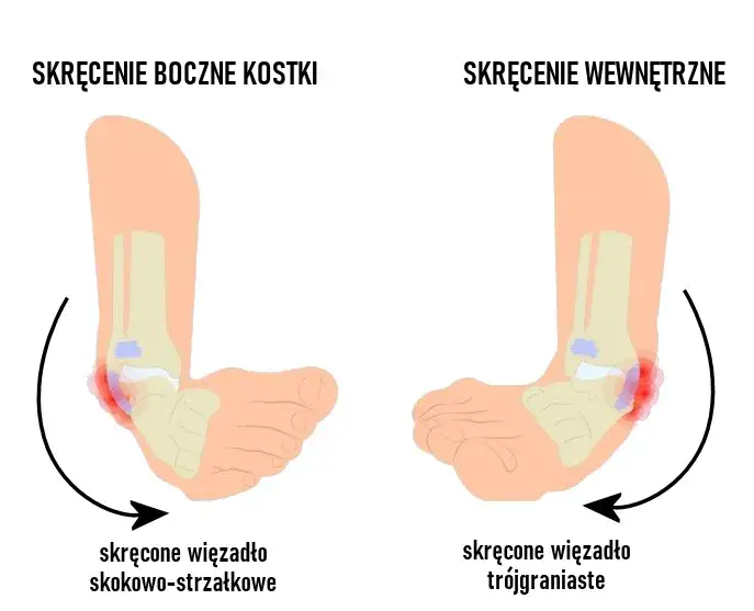 Zdjęcie Skręcenie stawu skokowego - ile trwa leczenie i co warto wiedzieć