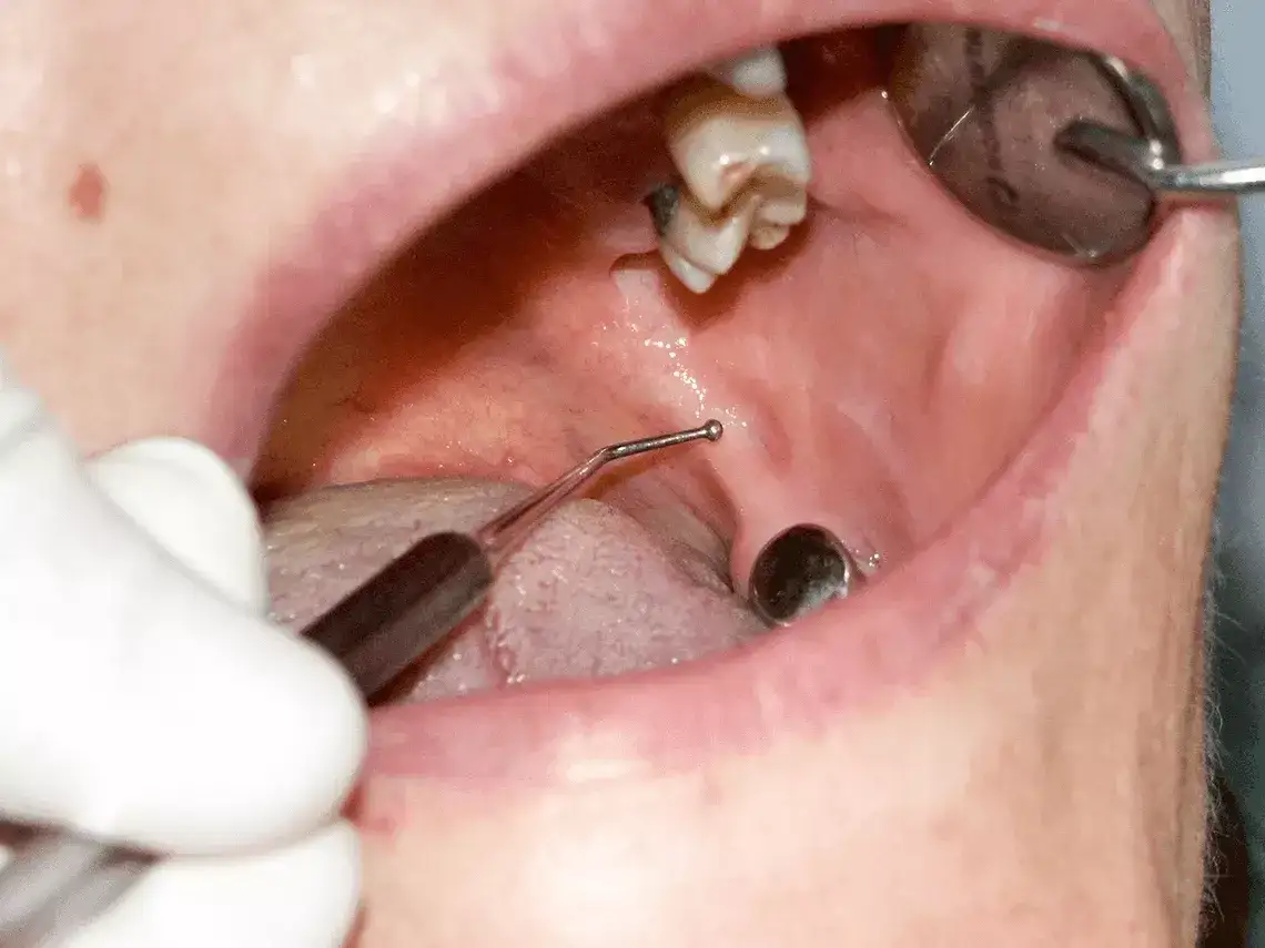 Zdjęcie Gdzie z bólem zęba Chełm? Znajdź natychmiastową pomoc dentystyczną