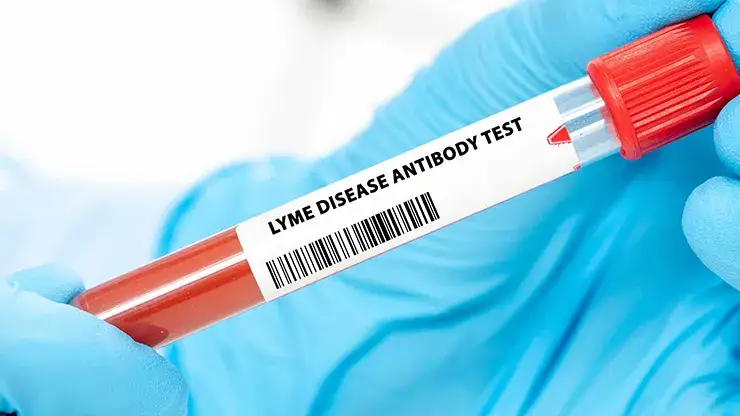 Zdjęcie Jak odczytać wyniki badań na boreliozę i uniknąć fałszywych diagnoz